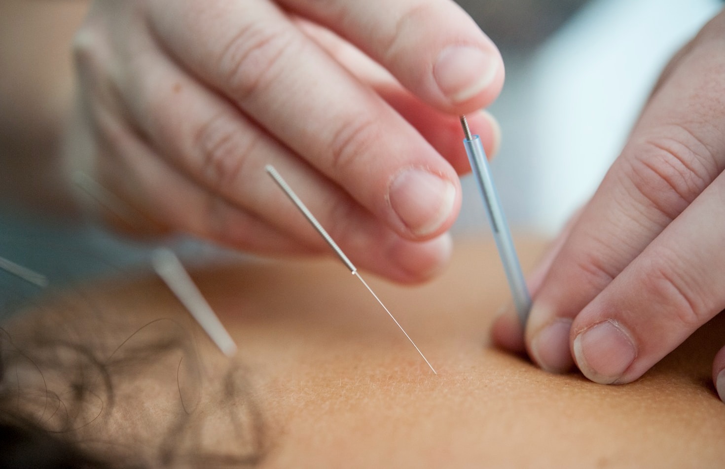 Beneficios de la acupuntura para el estrés